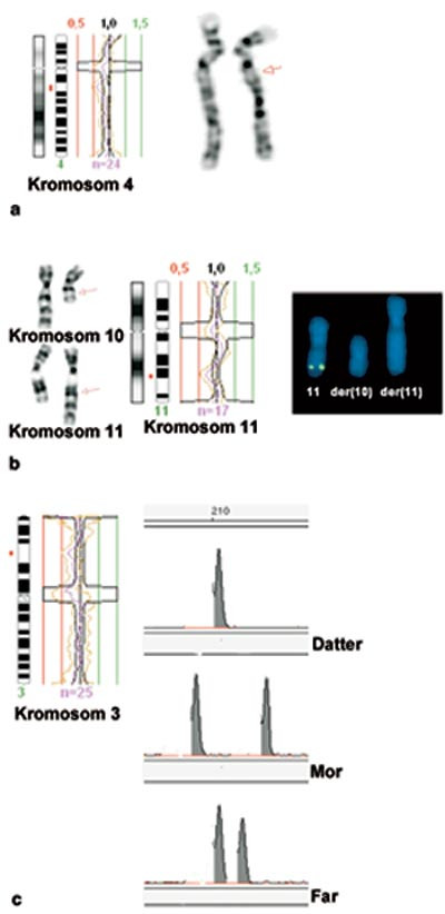 Figur 5  CGH-analyse av barn med mental retardasjon og dysmorfe trekk. a) En delesjon p&aring; den lange armen av kromosom 4 er&hellip;