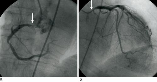 Figur 2  Koronarangiografi hos pasient 1. H&oslash;yre koronararterie (a) har en trang stenose ved avgangen fra aorta (pil) og det&hellip;