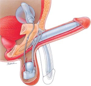 Figur 2  Slik er implantatet plassert i pasienten. Figurene er gjengitt med tillatelse: AMS 700TM Penile Prosthesis,&hellip;