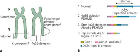 a) Facioskapulohumeral muskeldystrofi (FSHMD) oppst&aring;r p&aring; grunn av delesjon i den terminale del av kromosom 4 (telomer) (1)&hellip;