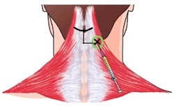 Diagnostisk blokade av n. occipitalis major. Man palperer protuberantia occipitalis externa i midtlinjen, og g&aring;r ca. 2 cm&hellip;