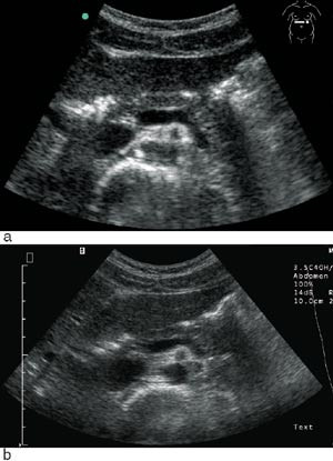 Figur 2  a) Et standard ultrasonogram av et transversalt snitt i abdomen ved bruk av SonoSite 180-skanner. b) Omtrent det&hellip;