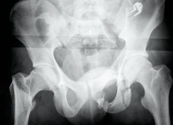 Figur 2  R&oslash;ntgen av bekkenet p&aring; pasient 2 etter innkomst. Pasientens bekken ble bed&oslash;mt som stabilt ved unders&oslash;kelse p&aring;&hellip;