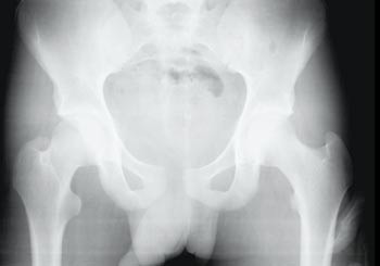 Figur 3  R&oslash;ntgen av bekkenet p&aring; pasient 4 etter innkomst. Bekkenet ble bed&oslash;mt som stabilt og pasienten angav ikke smerter&hellip;