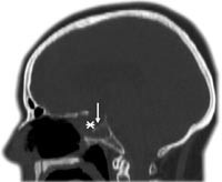 Figur 2  CT caput rekonstruert i parasagittalplan (pasient 2). Beindefekter finnes i fremre veggen (asterisk) og i gulvet av&hellip;