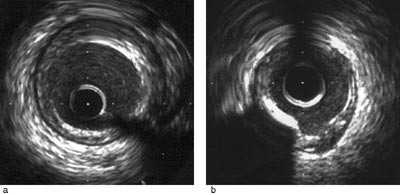Figur 2  Arterier med aterosklerotisk plakk. a) Fibr&oslash;st plakk omgitt av ekkosvak media. Artefakt fra vaier kl 5. b) Plakk&hellip;