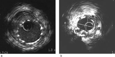 Figur 4  Stentplassering. a) Normalt plassert stent med symmetrisk &aring;pning av stenten i kontakt med karveggen i hele&hellip;