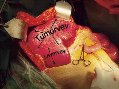 Figur 6  Foto tatt peroperativt viser tumors utbredelse og resterende normalt levervev