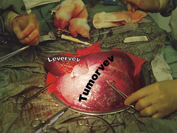 Figur 7  P&aring;begyntex situ-reseksjon av tumor