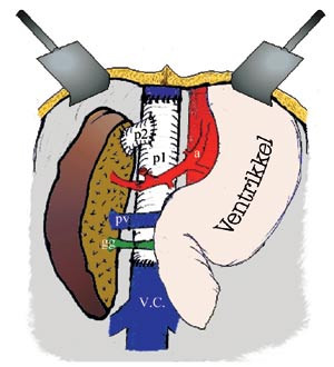 Figur 8  Skisse som viser autotransplantert h&oslash;yre leverlapp. V.C.= v. cava, a = a. coeliaca med proksimal stenose, p1 =&hellip;