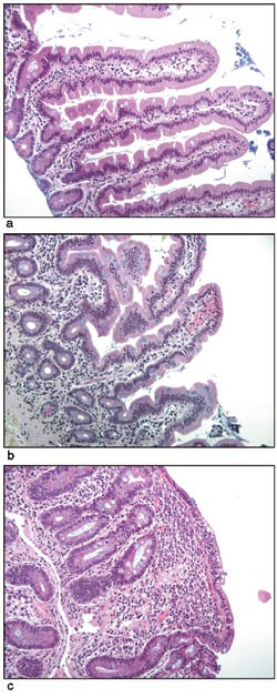 Figur 2  a) Velorientert tarmslimhinne med normale totter (Marsh 0). b) Relativt velorientert slimhinne med tydelig &oslash;kt&hellip;