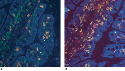 Figur 3  a) Immunfluorescensunders&oslash;kelse av andelen T-celler (CD3-positive, gr&oslash;nne) som uttrykker den alternative gamma&hellip;