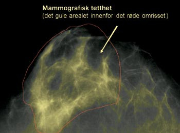 Figur 1c  Operat&oslash;ren fargelegger gult de lyse omr&aring;dene som representerer mammografisk tetthet. Programmet regner ut&hellip;