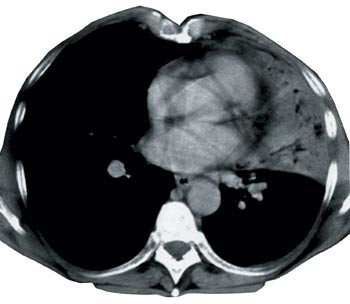 Figur 2  Mye artefakter i bilde med mediastinumvindu ved unders&oslash;kelse i konvensjonell, aksial skanner. Eksponeringstid 3 sek&hellip;