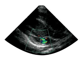 Figur 2  Ekkokardiografi av pasient 1. Mitralinsuffisiens grad 1/4. 2D-ekkokardiografi med fargedoppler fra parasternal&hellip;
