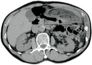 Figur 2  CT-bilde (spiralteknikk 8/12/5, ingen kontrast) fra samme pasient som i figur 1. Like under bukveggen i venstre&hellip;