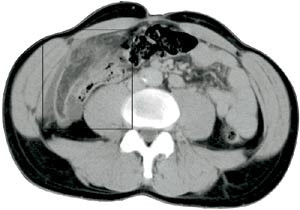 Figur 4  Samme pasient som i figur 3. CT (spiralteknikk 8/12/5, intraven&oslash;s kontrast) viser oppfylling av skarpt avgrenset&hellip;