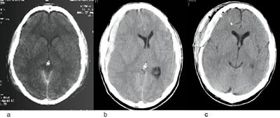Figur 3  a) CT fra Christchurch, New Zealand, b og c) fra Troms&oslash;. a) Redusert tetthet over begge frontallapper, forenlig med&hellip;