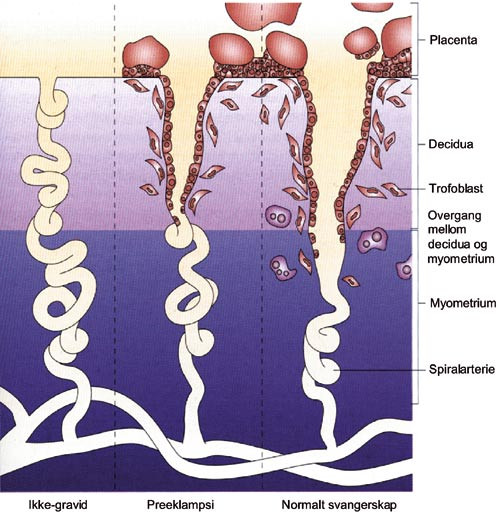 Figur 3 Fremstilling av uterine spiralarterier hos ikke-gravid, under normal graviditet og ved preeklampsi (5)&hellip;