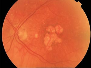 Figur 2  Aldersrelatert maculadegenerasjon: atrofisk type med tap av pigmentepitel. Koroidalkarene vises tydelig i de&hellip;