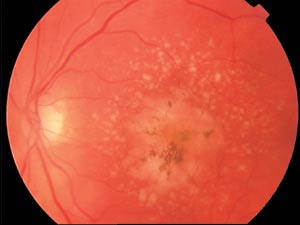 Figur 3  Aldersrelatert maculadegenerasjon: v&aring;t type med sentralt &oslash;dem, pigmentopphopninger og druser. Nedsatt visus til&hellip;