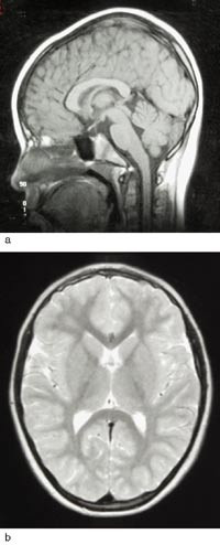 Figur 2  a) Sagittal T1-vekta sekvens ved vel &aring;tte &aring;rs alder. Corpus callosum er heilt normal. b) Aksial T2-vekta sekvens&hellip;