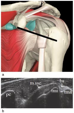 Figur 2  Ventral-transversal projeksjon: a) Anatomi med plassering av lydhodet b) Mellom tuberculum majus (tma) og&hellip;
