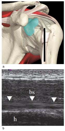 Figur 3  Ventral-longitudinal projeksjon: a) Anatomi med plassering av lydhodet b) Ultralydbilde av bicepssenen (bs .) p&aring;&hellip;