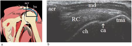 Figur 5  Lateral-longitudinal projeksjon: a) Anatomi med musculus supraspinatus (m.ssp) i lengdesnitt, bursa (bu) og&hellip;