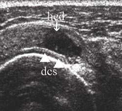 Figur 7  Lateral-transversal projeksjon. Akutt rotatorcuffruptur med hypoekkoisk defekt (hed) og &laquo;double cortex sign&raquo; (dcs)