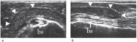Figur 10  a) Ventral-transversal projeksjon med intraartikul&aelig;r v&aelig;skehalo rundt bicepssenen (bs). Anteriort en stor v&aelig;skefylt&hellip;