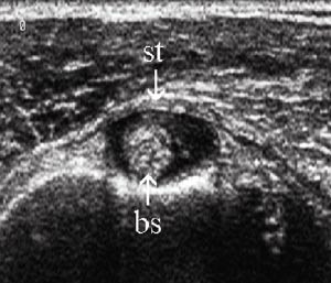 Figur 11  Ventral-transversal projeksjon av bicepssenen (bs) &oslash;verst i sulcus. Man ser typiske tegn for tenosynovitt med&hellip;
