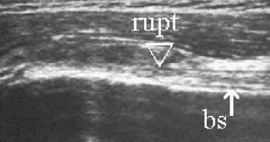 Figur 13  Ventral-longitudinal projeksjon. Ruptur av den lange bicepssenen (bs) med avbrekk av den normale fibrill&aelig;re&hellip;