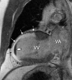 Figur 2  Tokammer MR-bilde av venstre ventrikkel (VV) viser forsinket kontrastoppladning i stort fremreveggsinfarkt (sm&aring;&hellip;