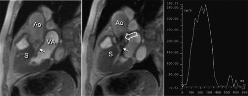 Figur 3  Hypertrofisk obstruktiv kardiomyopati. MR av venstre ventrikkel med utl&oslash;pstractus til aorta (Ao) og mitralostiet. I&hellip;