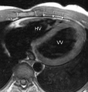 Figur 4  H&oslash;yre ventrikkel-dysplasi. Aksialt MR-bilde viser fokalt redusert tykkelse av h&oslash;yre ventrikkels frie vegg (piler)&hellip;