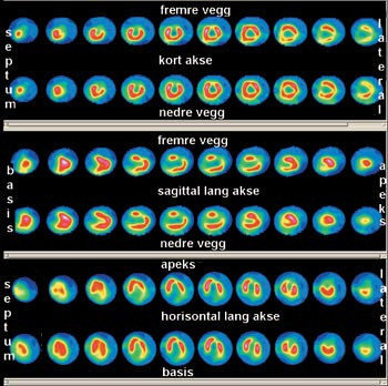 Figur 2  Myokardscintigrafi som viser permanent opptaksdefekt i fremre vegg, dvs. gjennomg&aring;tt fremreveggsinfarkt. Videre ses&hellip;