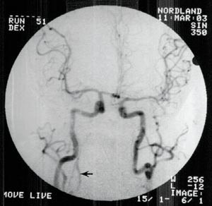 Figur 2  Arkografi viser intakt sirkulasjon i a. carotis interna, a. cerebri media og a. cerebri anterior p&aring; begge sider&hellip;