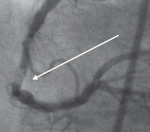 Figur 2  H&oslash;yre koronararterie med trombe i midtre del (pil). Bildet er utl&aring;nt av Hjerte/kar radiologisk avdeling, Ullev&aring;l&hellip;