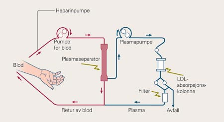 LDL&thinsp;&thinsp;-aferese med forutg&aring;ende plasmaseparasjon fra KANEKA. Pasientens plasma utskilles ved hjelp av plasmaseparator og&hellip;