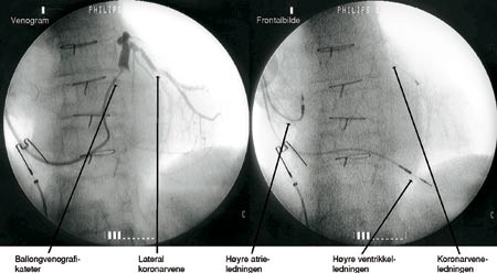 Figur 2  Venogrammet viser venografikateter med oppbl&aring;st ballong p&aring; tuppen lokalisert i sinus coronarius hos en av v&aring;re&hellip;