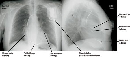 Figur 3  R&oslash;ntgen thorax av pasient med kombinert biventrikul&aelig;r pacemakerdefibrillator