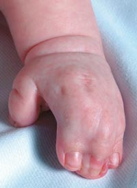 Figur 2  Aperts syndrom. Merk alvorlig sammenvoksning av andre til femte finger (syndaktyli)