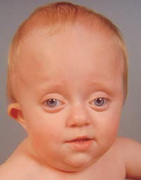 Figur 3  Crouzons syndrom. Pasienten har en bred, h&oslash;y og kort hodeform (brakykefali), underutviklet mellomansikt og&hellip;