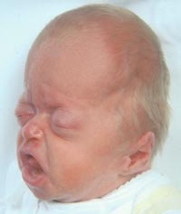 Figur 4  Pfeiffers syndrom type 2. Pasienten har den alvorligste form for kraniosynostose, s&aring;kalt kl&oslash;verbladskalle, hvor&hellip;