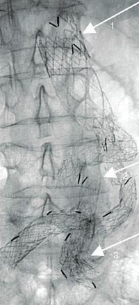 Figur 2  Oversiktsbilde som viser desintegrasjon av stentgraftskjelett. Pil 1 peker p&aring; l&oslash;sning av siggrad i halsfestet. Pil&hellip;
