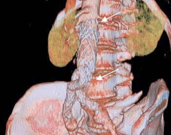 Figur 3  Rekonstruksjon av CT aorta. Pil 1 peker p&aring; desintegrasjon av siggraden ved aneurismehalsen. Pil 2 peker p&aring; myke&hellip;