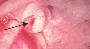 Figur 2  Duodenoskopi. Bl&oslash;dning fra papilla Vateri (pil)