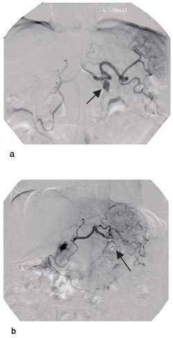 Figur 3  a) Angiografi. Pilen viser et 20 mm stort aneurisme p&aring; miltarterien.  b) Angiografi. Aneurismet er n&aring; vellykket&hellip;