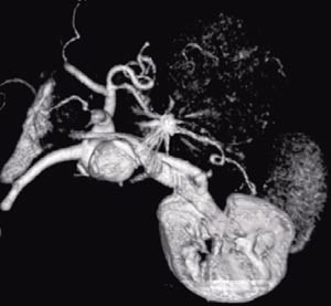 Figur 4  Tredimensjonal rekonstruksjon ved CT&thinsp;-angiografi. Det emboliserte aneurismet er i sentrum av bildet